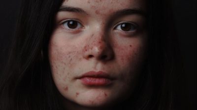 CBD Oil and Acne girl with acne