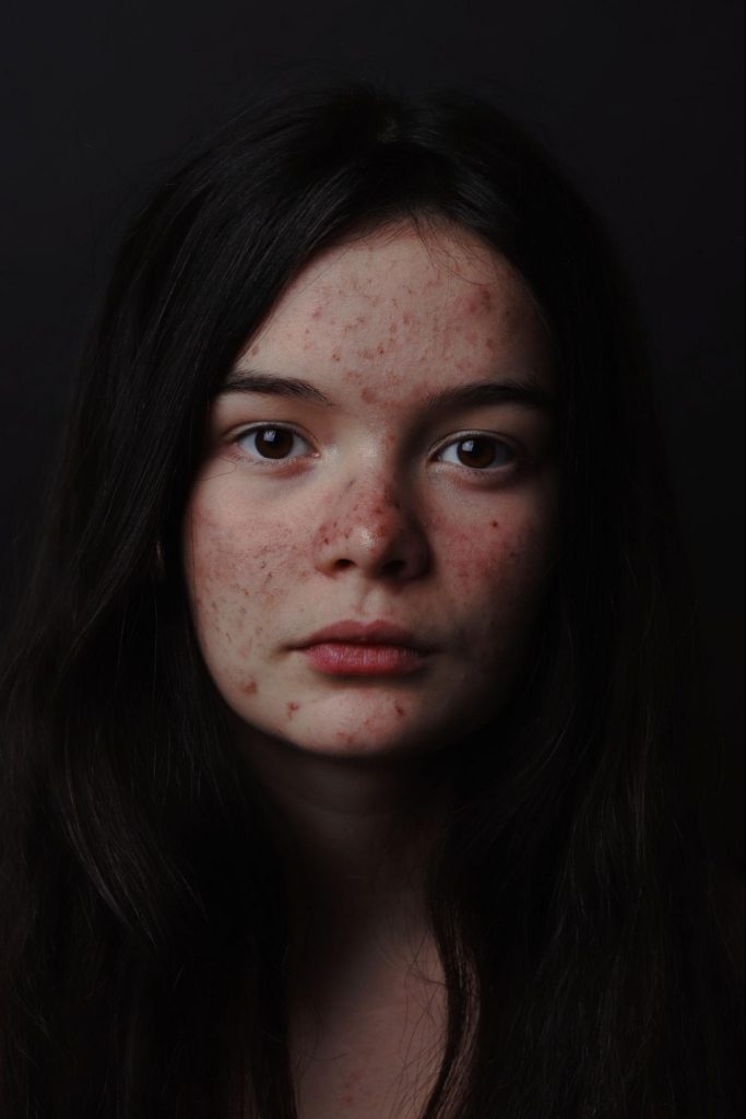 Girl with Acne