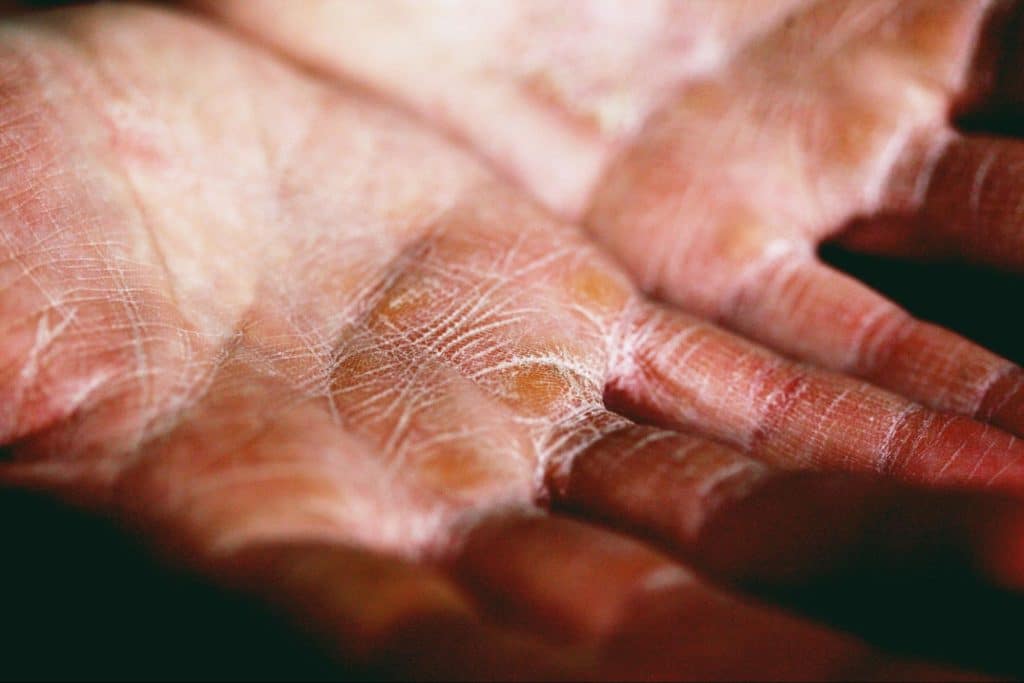 CBD oil treatment for Dermatitis hand