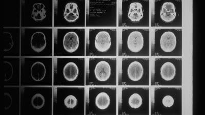 Brain Scan CBD Oil and Glioblastoma