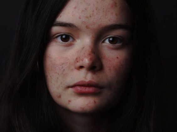 CBD Oil and Acne girl with acne