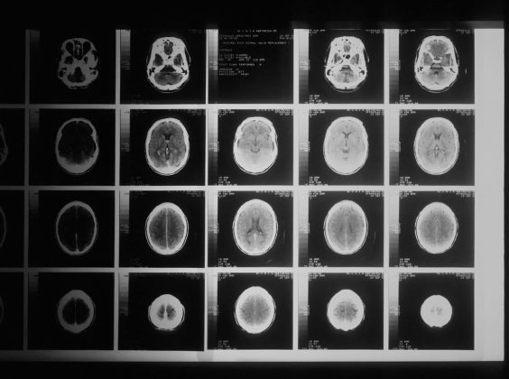 Brain Scan CBD Oil and Glioblastoma
